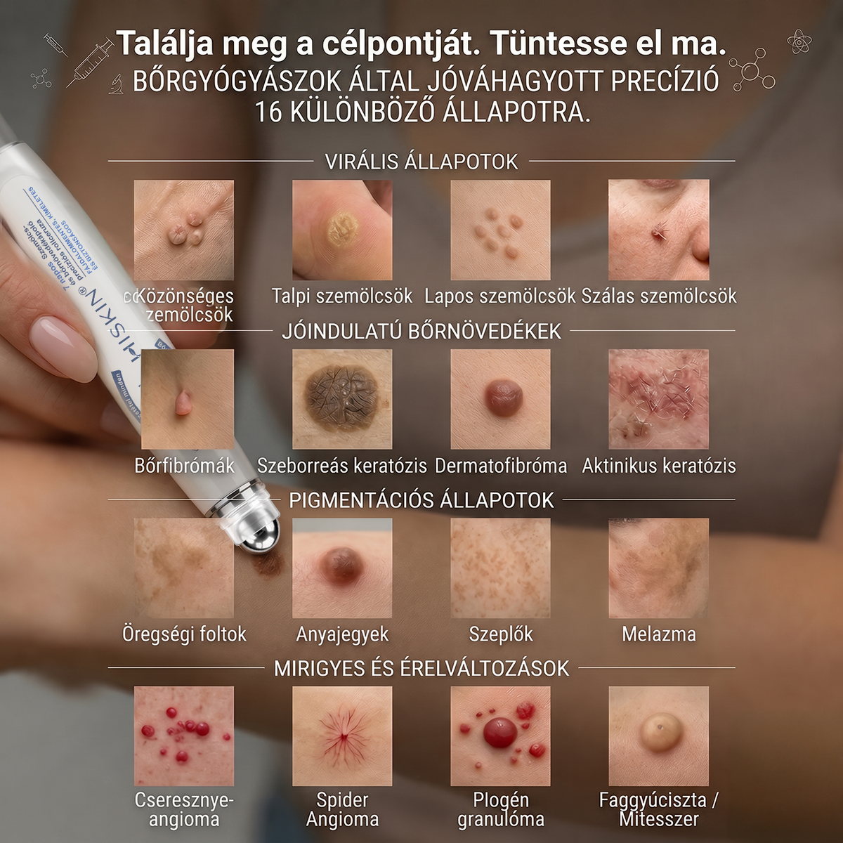 Hivatalos Márkabolt | 🚢🚢 Hiskin® 7 napos Szemölcseltávolító Roll-on Ápoló Folyadék (Fájdalommentes rollerball technológia, hegek nélkül) 🐬